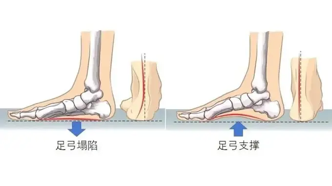 6类热门网红鞋健康风险揭秘 这几种穿法最伤脚